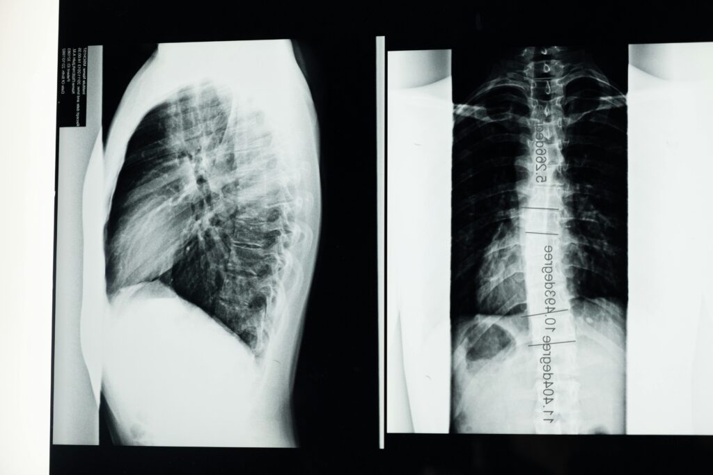 IEEE Young Engineers Conference High-resolution X-ray showing a detailed examination of human spine with scoliosis.